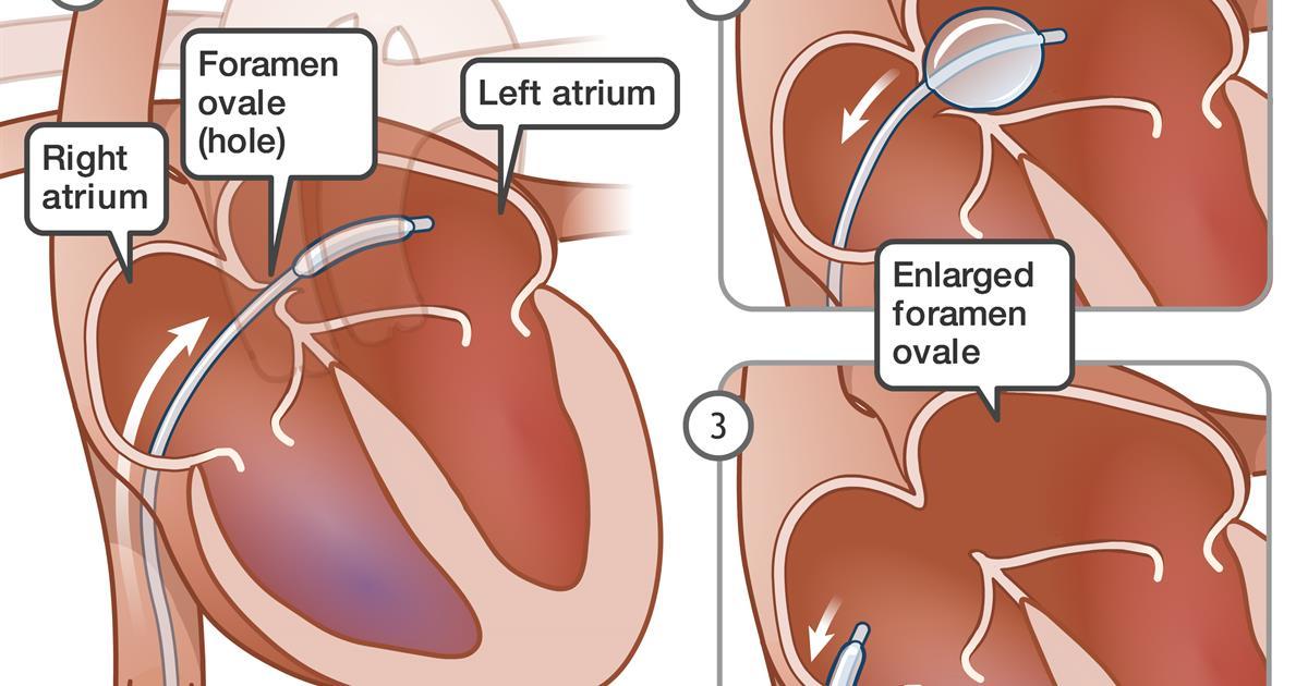 Balloon Septostomy